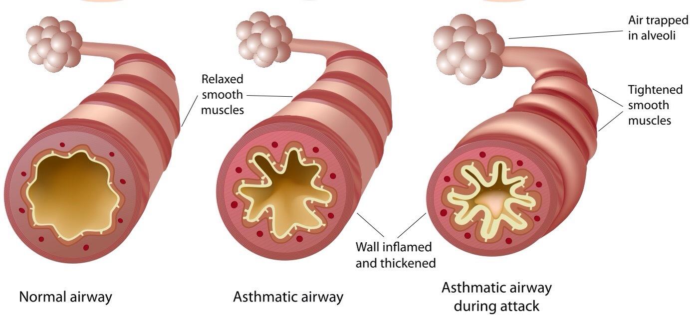 Asthma Diagram